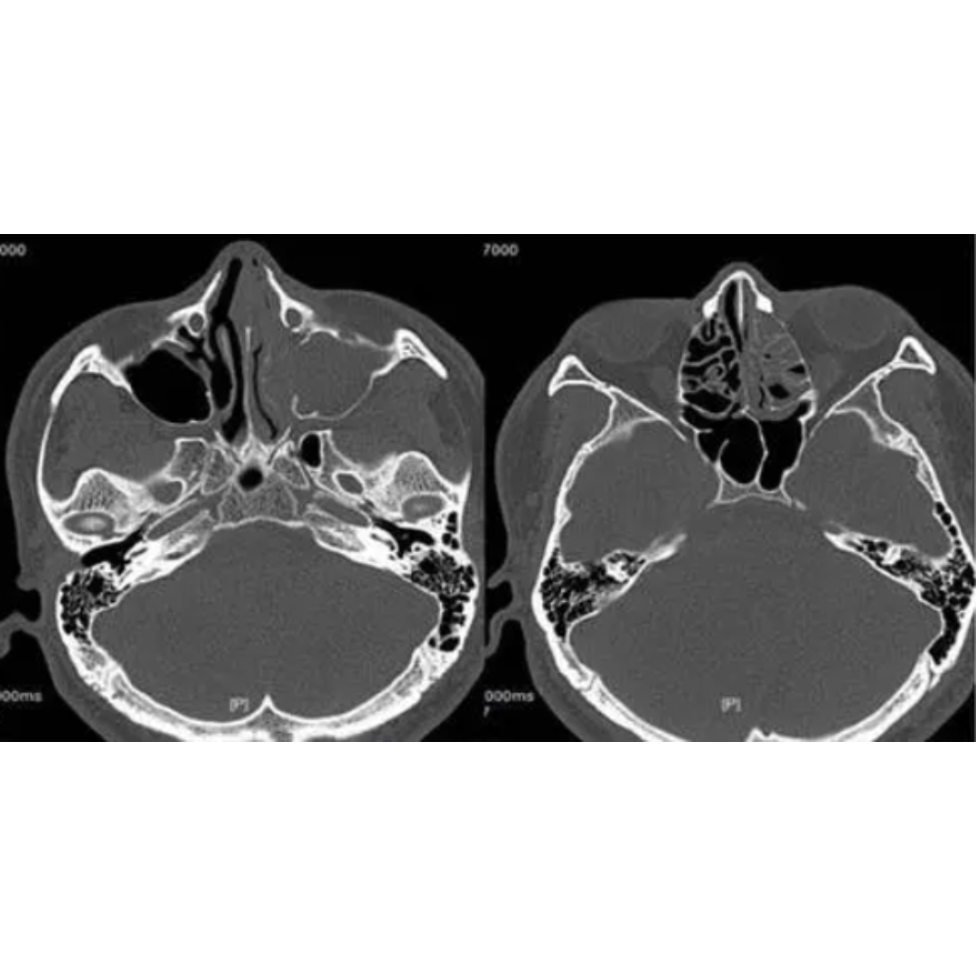 窦癌ct上颌窦囊肿ct图上颌窦囊肿低密度造影上颌窦积液ct上颌窦外侧壁