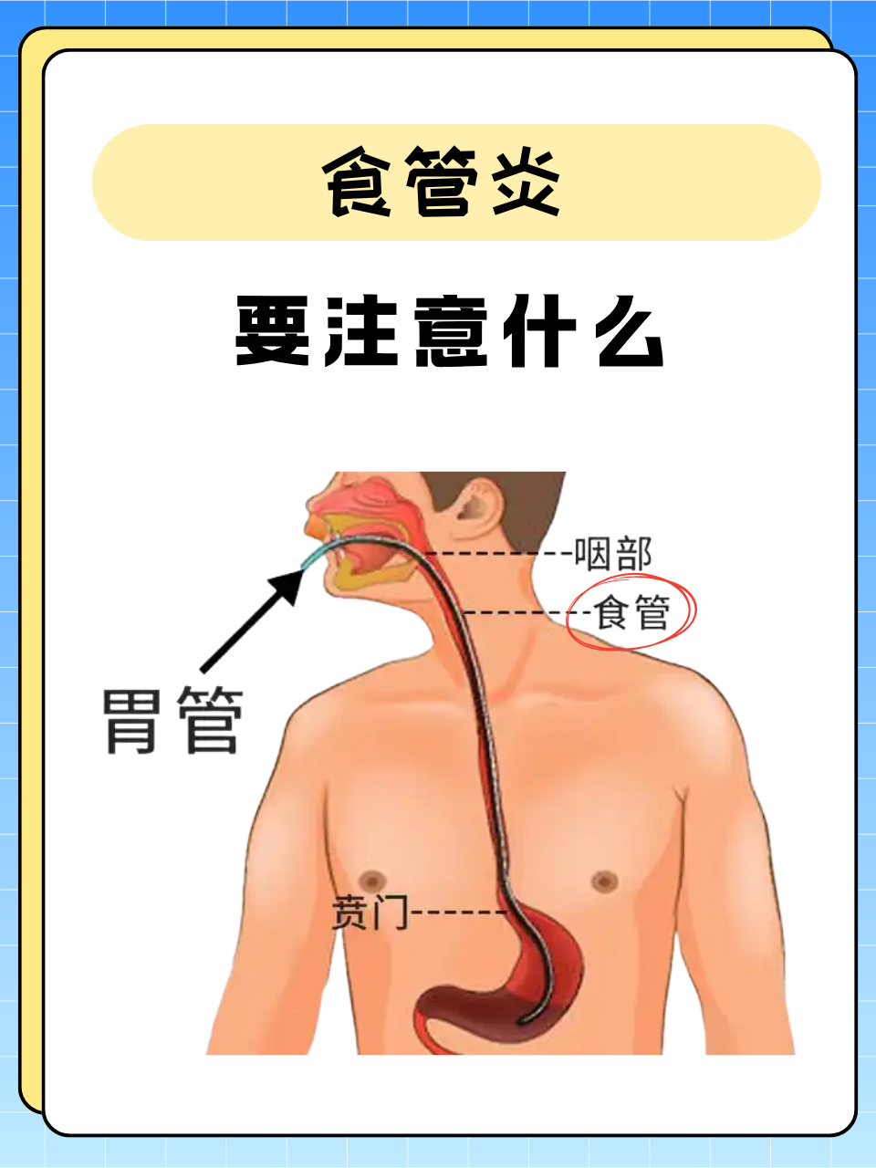 食管炎是常见的消化道疾病,典型表现为胸骨后灼热