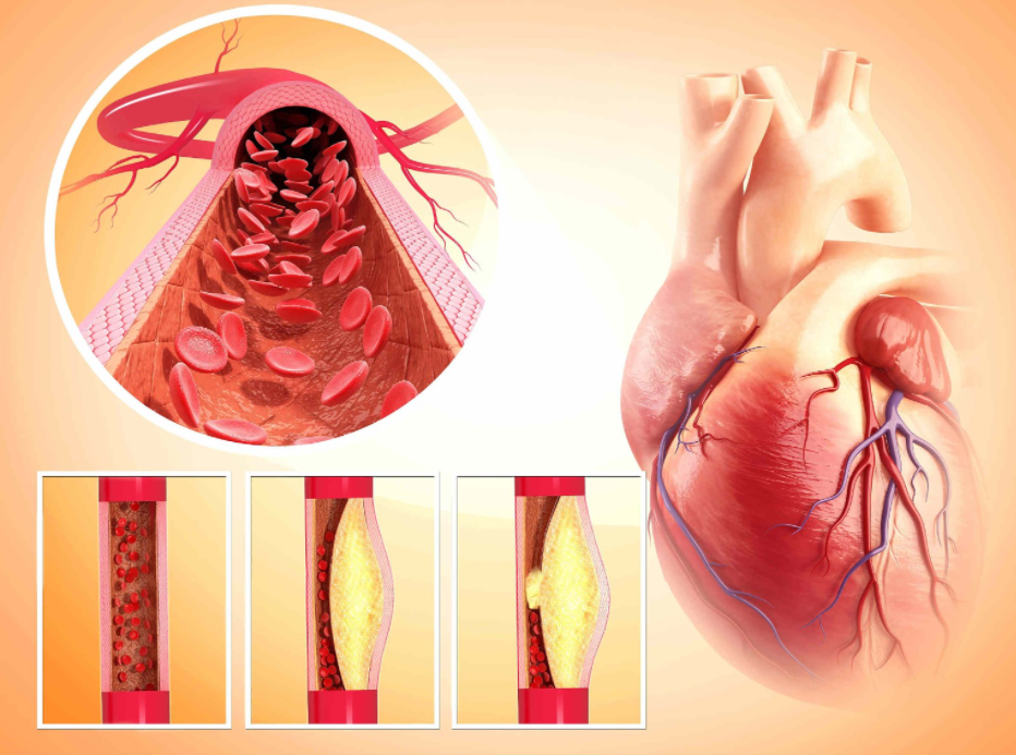 家里人有冠心病的,记住三句话,真心为你好!