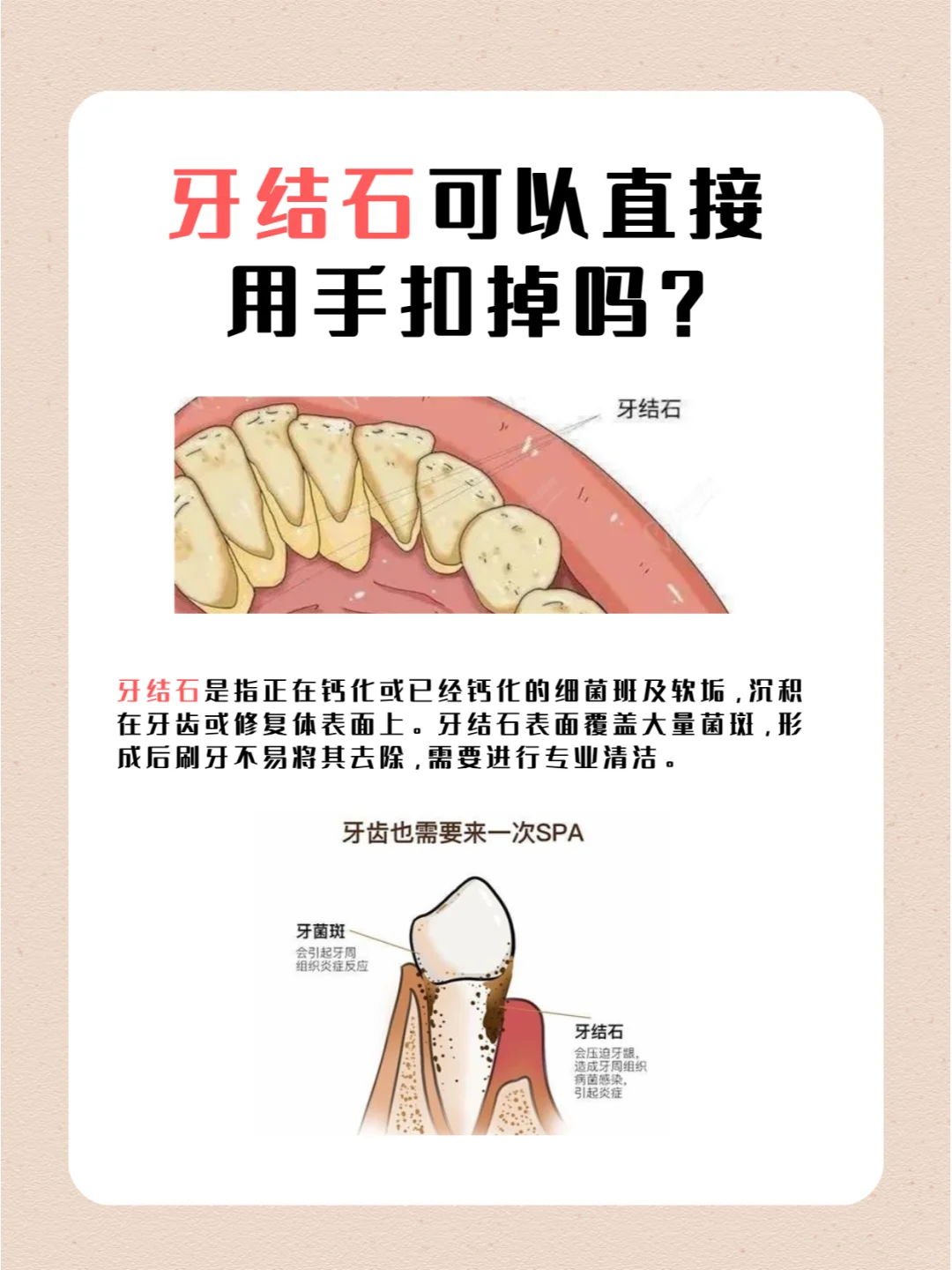 牙结石绝不能手抠,安全清除的秘诀