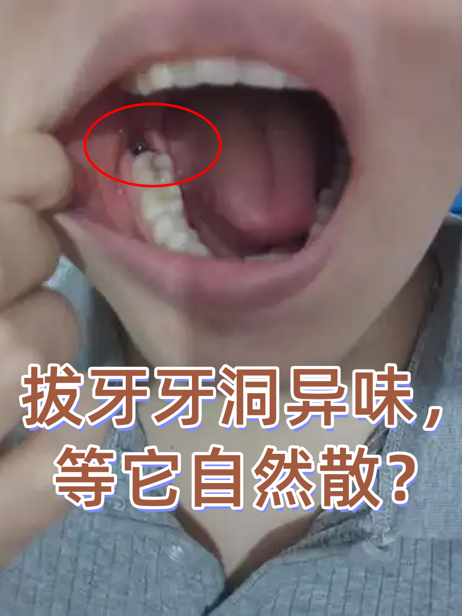 拔牙后牙洞腐臭通常不能自己好,这主要 拔牙后七天窟窿恢复图拔智齿
