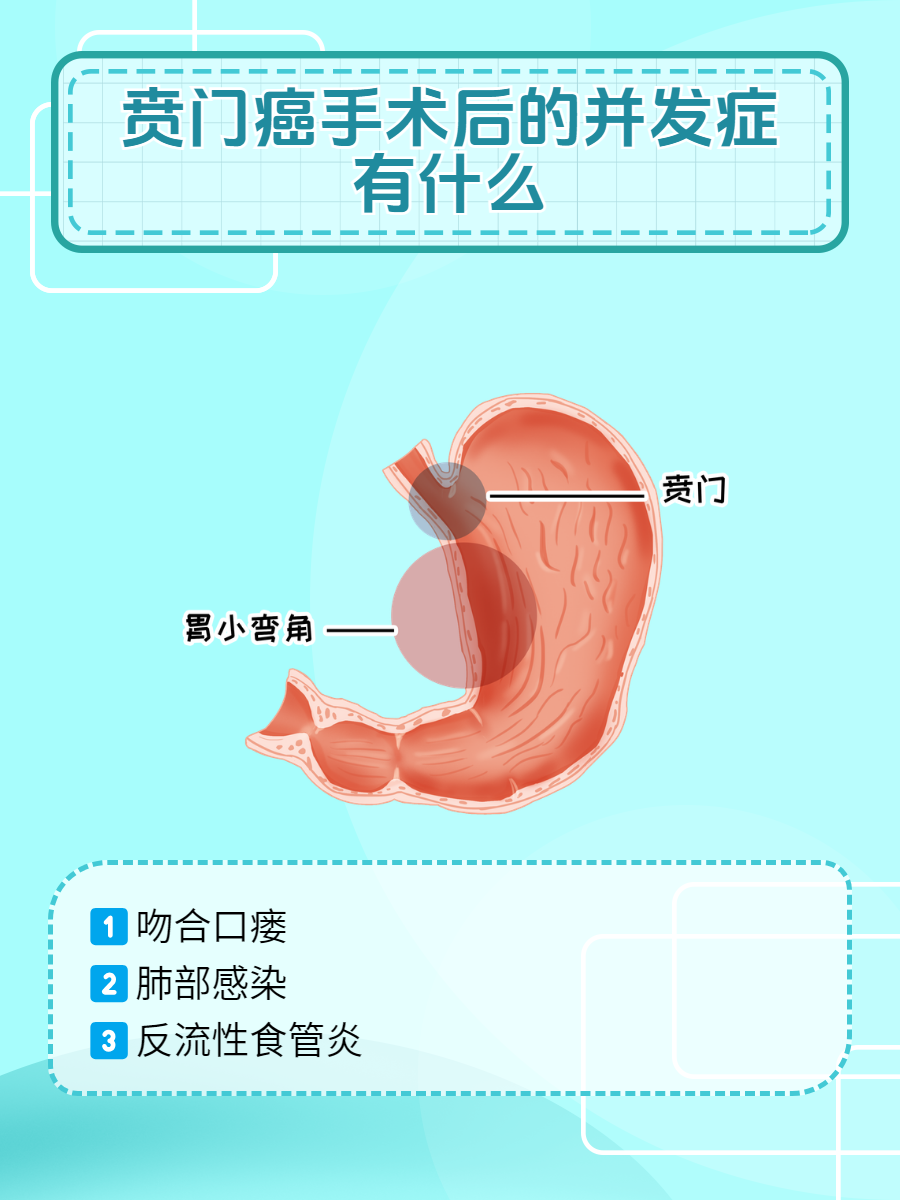 贲门癌