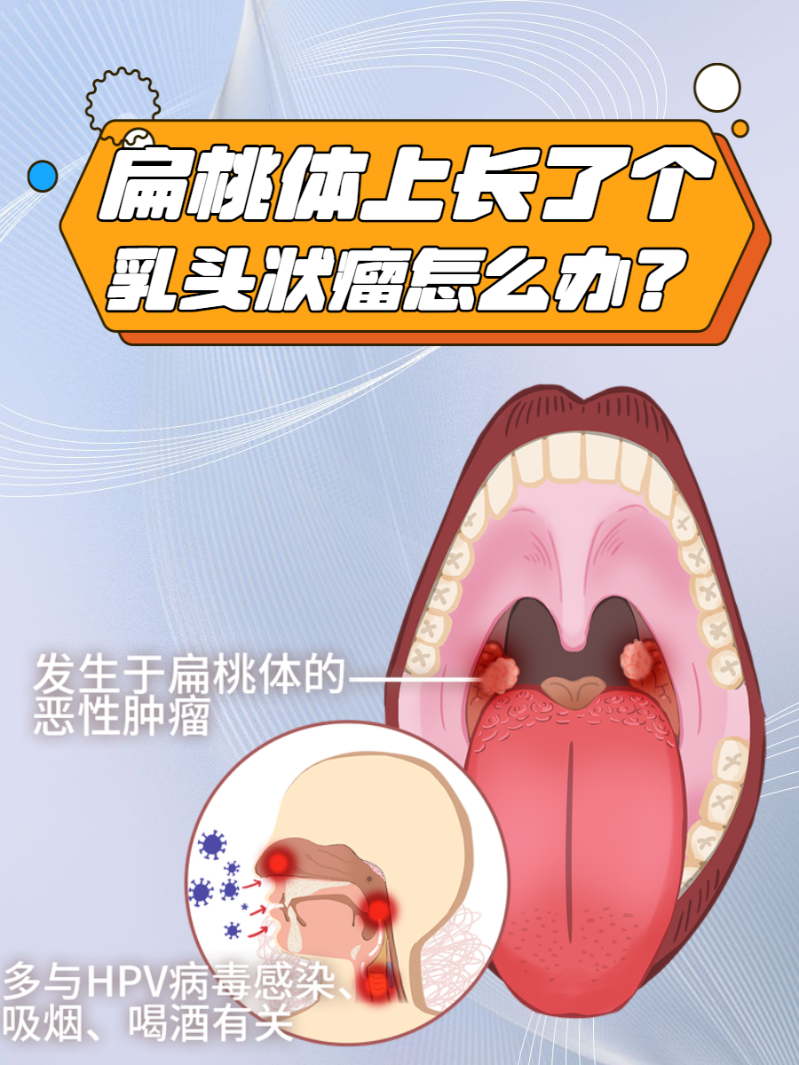 扁桃体上长了个乳头状瘤怎么办?