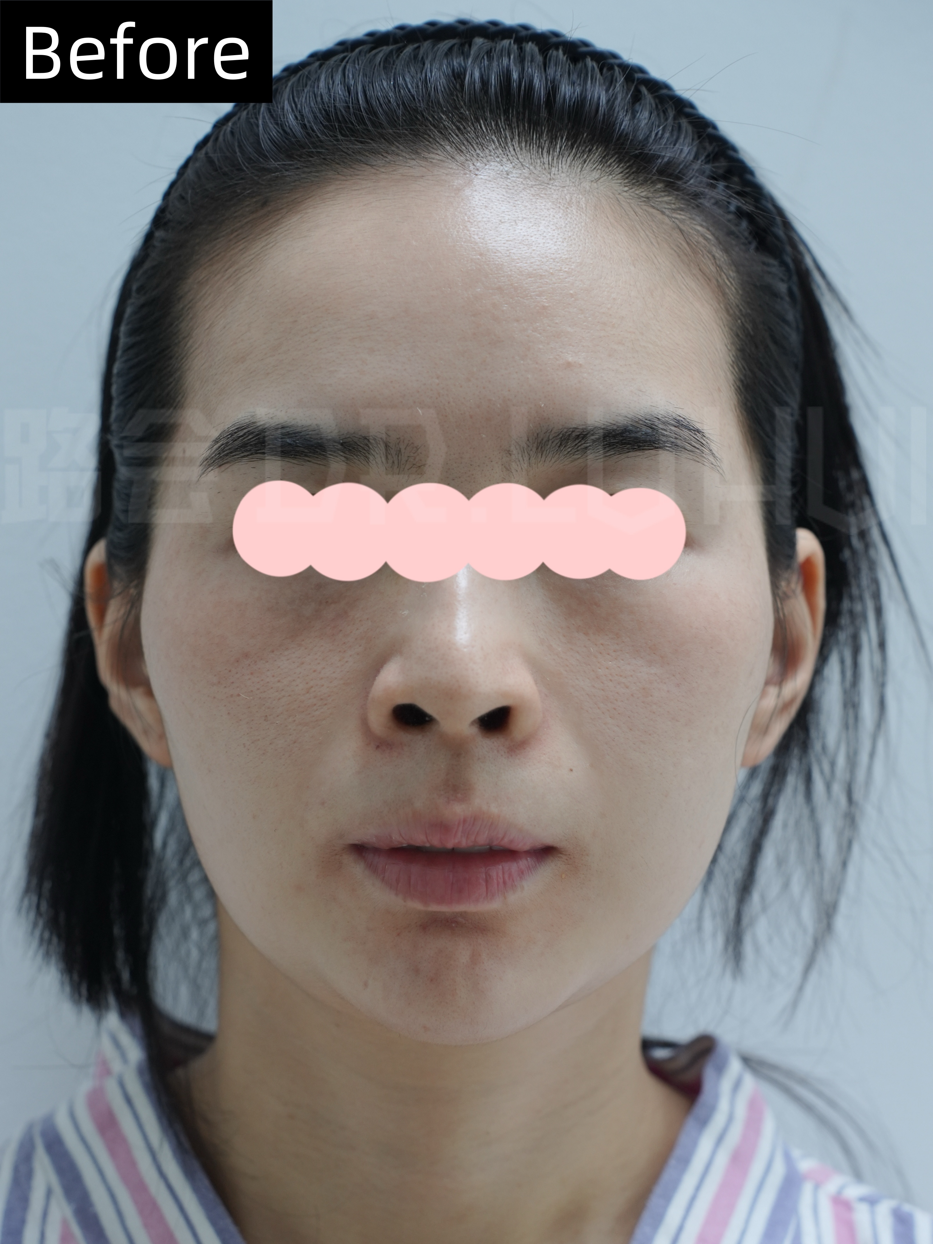 犹豫许久,终于下定决心做膨体填充太阳穴,首次公开手术过程  这是一位