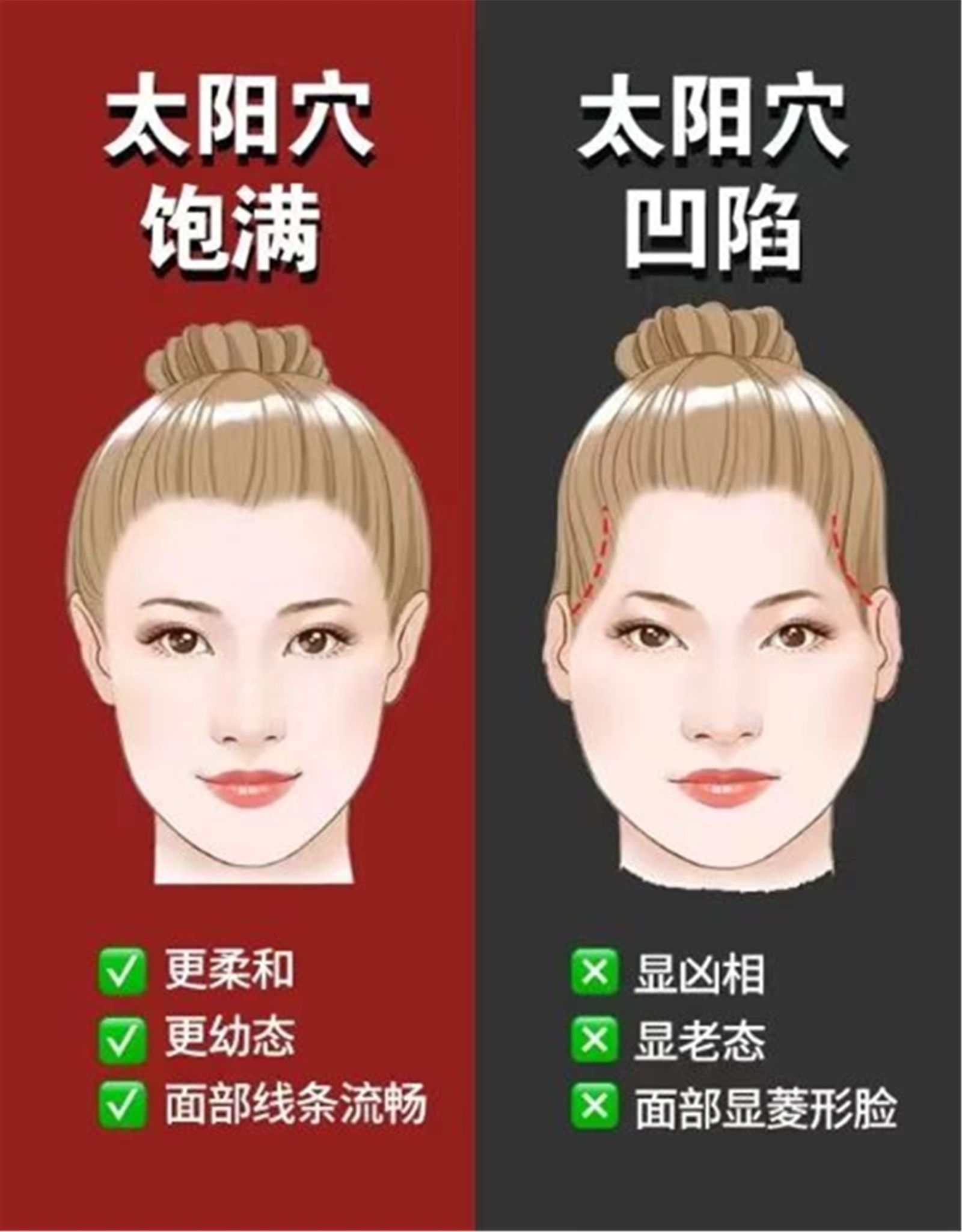 1,安全:通过手术方式填充,可以避免因玻尿酸,自体