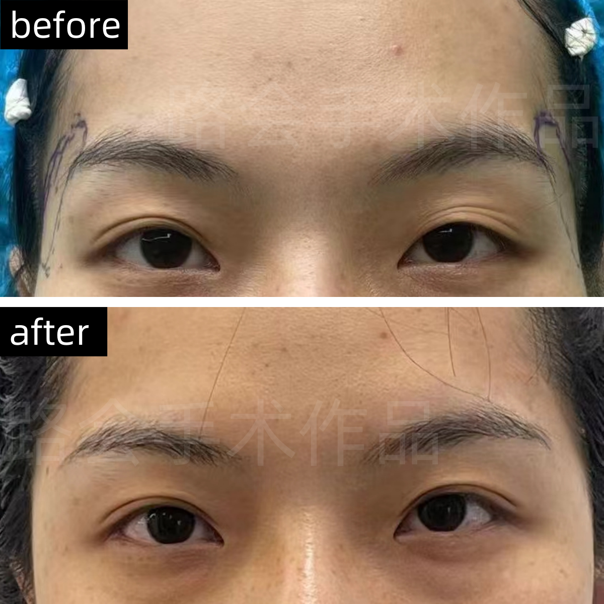 中重度的太阳凹陷,除了会形成菱形脸,还会因骨骼支持力不足,连带眉 