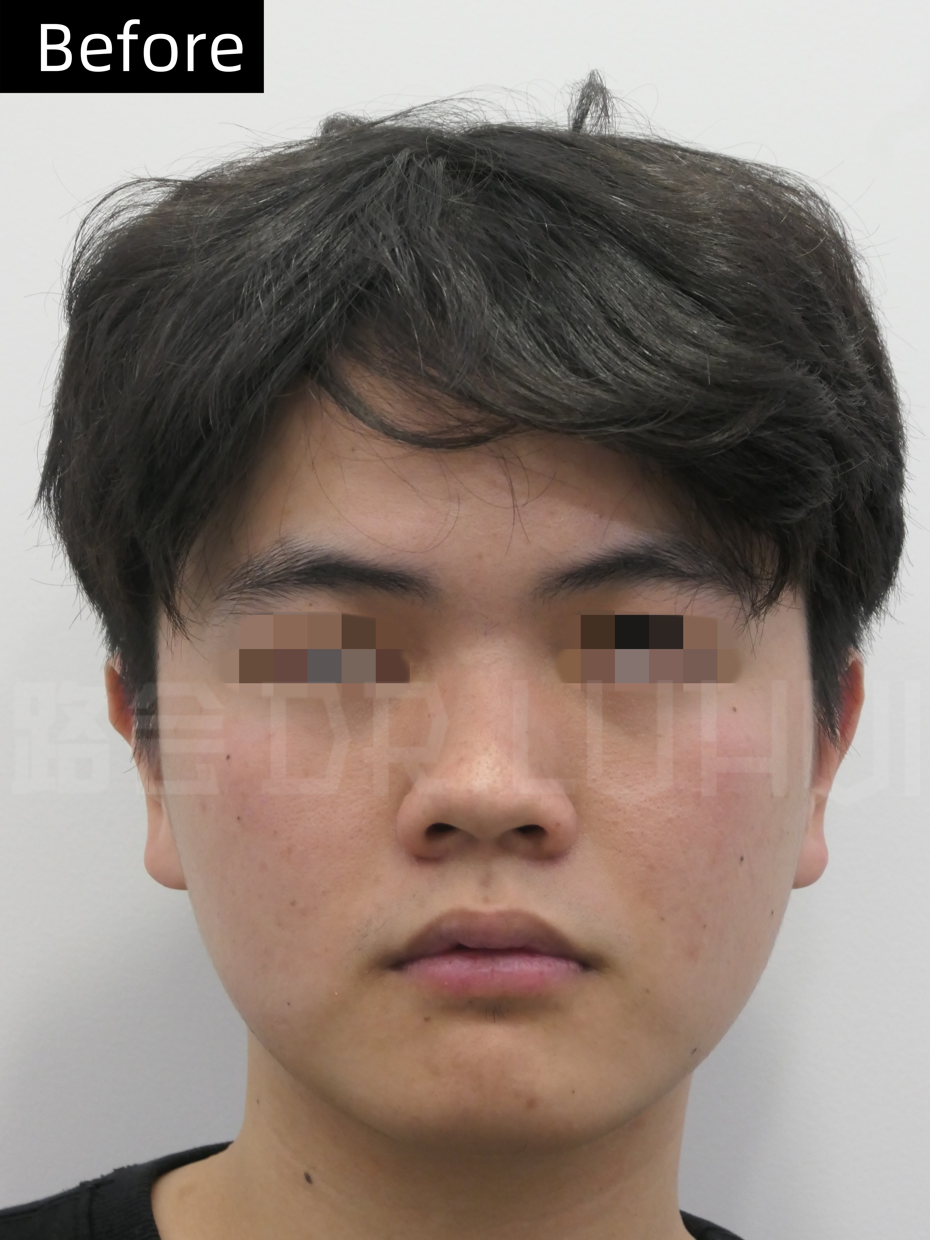 他说自己因为鼻子的问题已经自卑很多年了,感觉山根就像直接断掉似的