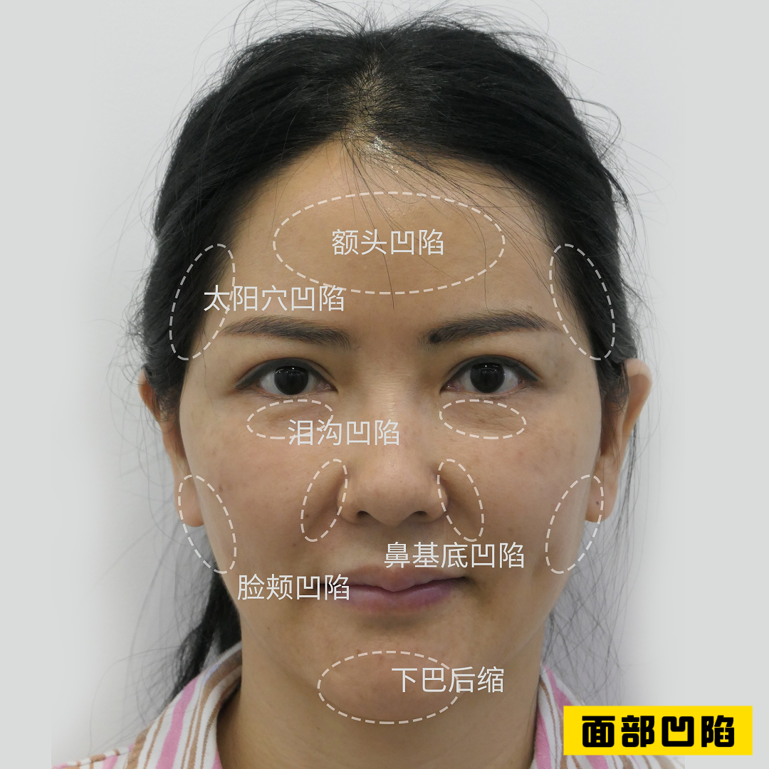 形面部凹陷颞部凹陷颧骨凹陷颧骨凹陷的面相脸颊凹陷的人面相脸部凹陷