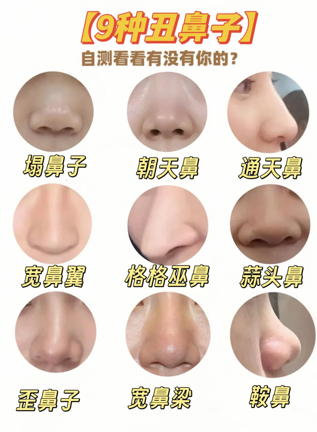 朝天鼻 特点:鼻尖上翘,鼻唇角过大,鼻孔外露明显,鼻梁短且塌鼻子筛