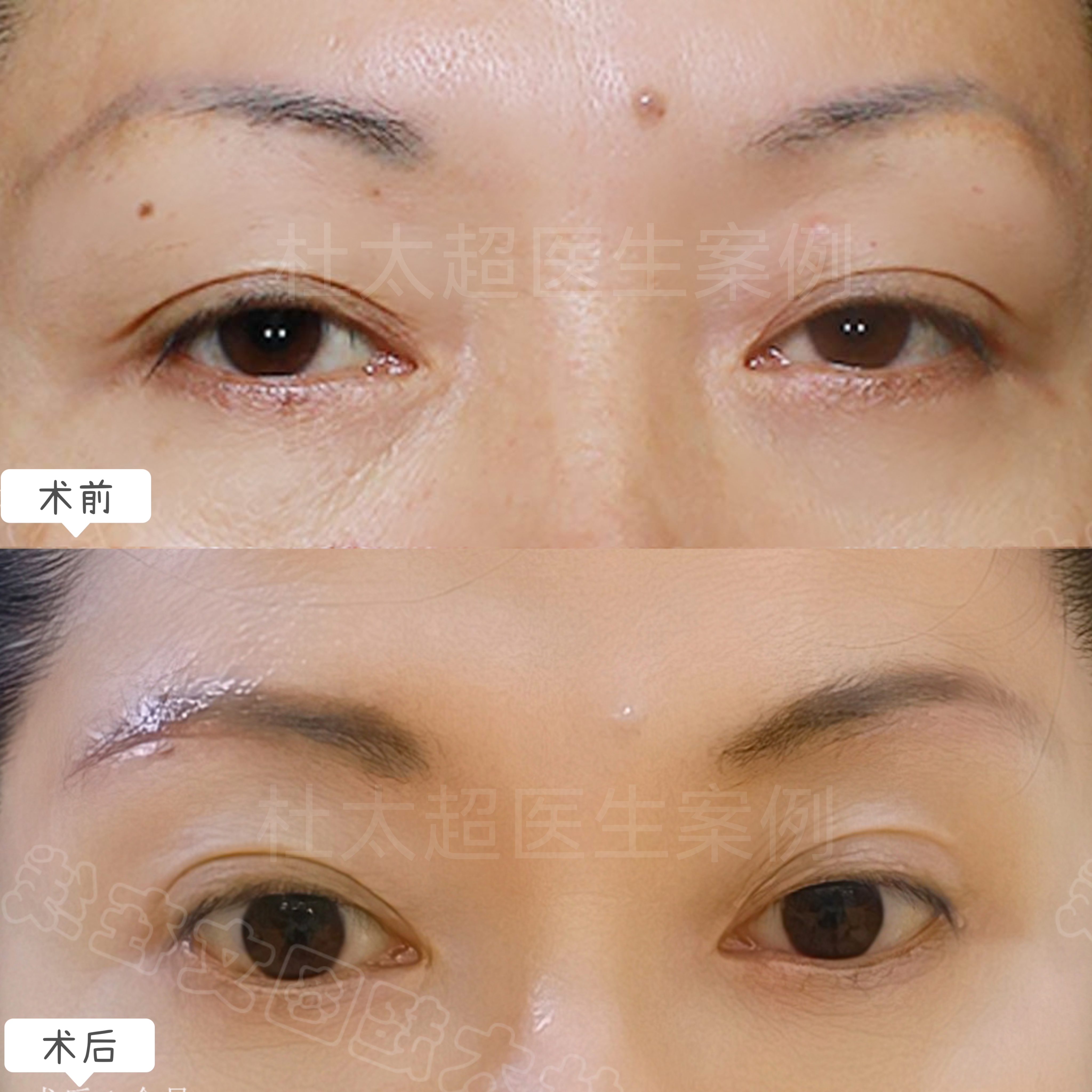 以最经济的成本,最小的身心负担,达到最大化的面部年轻化成效?