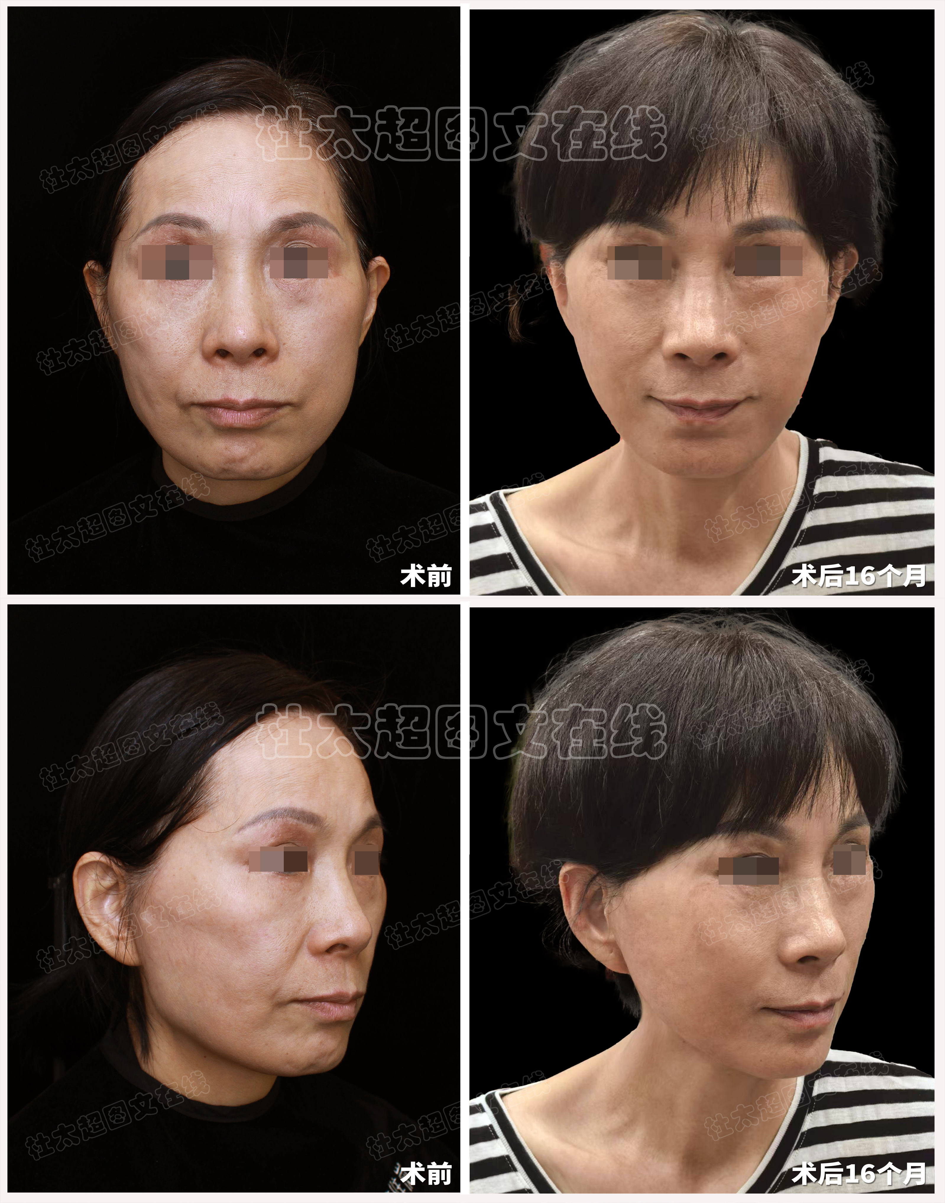 拉皮术手术后是否会导致发际线后移?