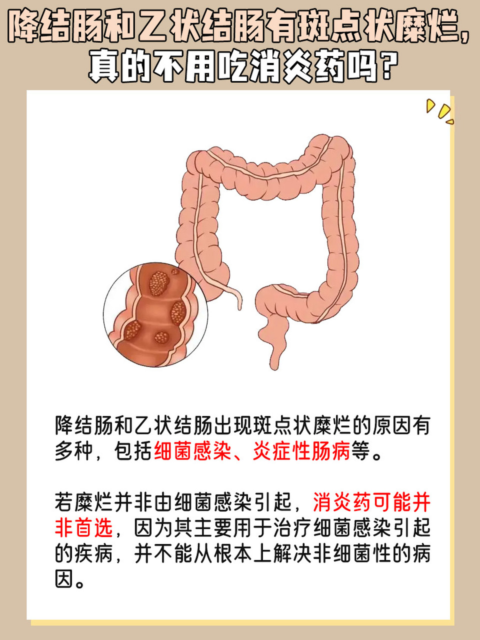 乙状结肠炎症图片