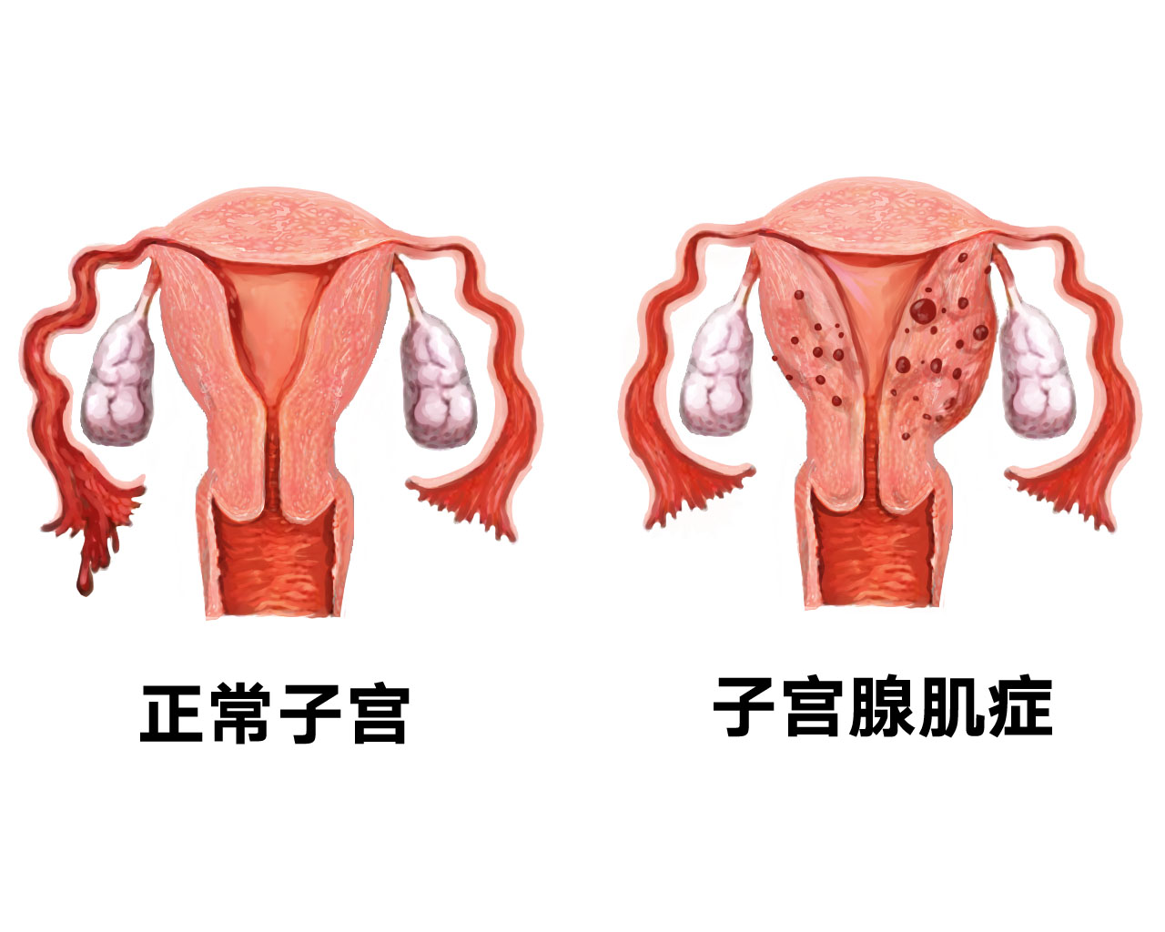 女性下腹附件图 子宫图片