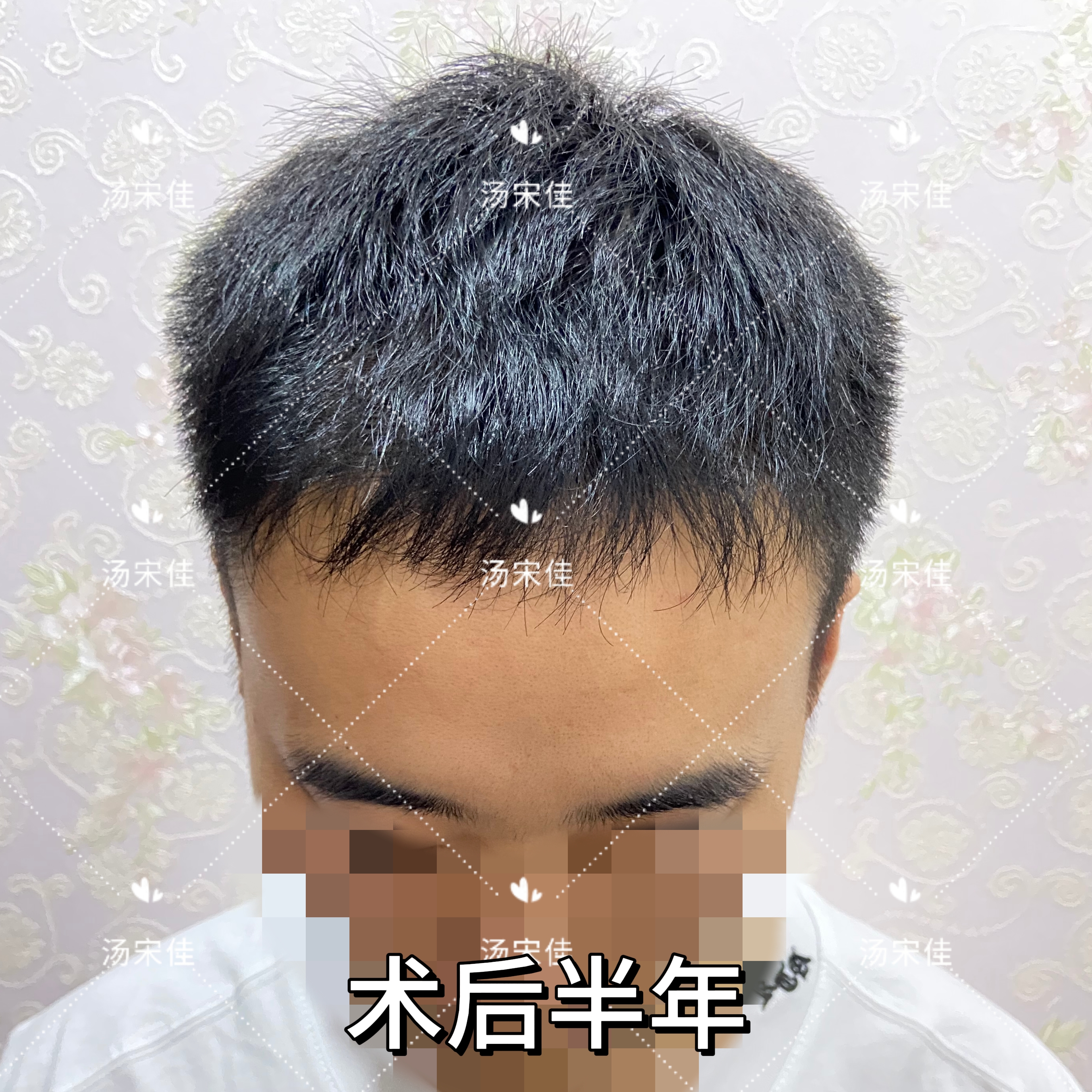 分享植发2000毛囊单位恢复了一年的记录