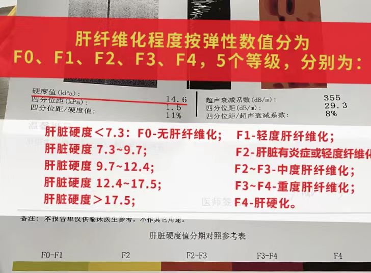 3-9.7之间,表示肝脏有炎症或轻度纤维化;大于12.