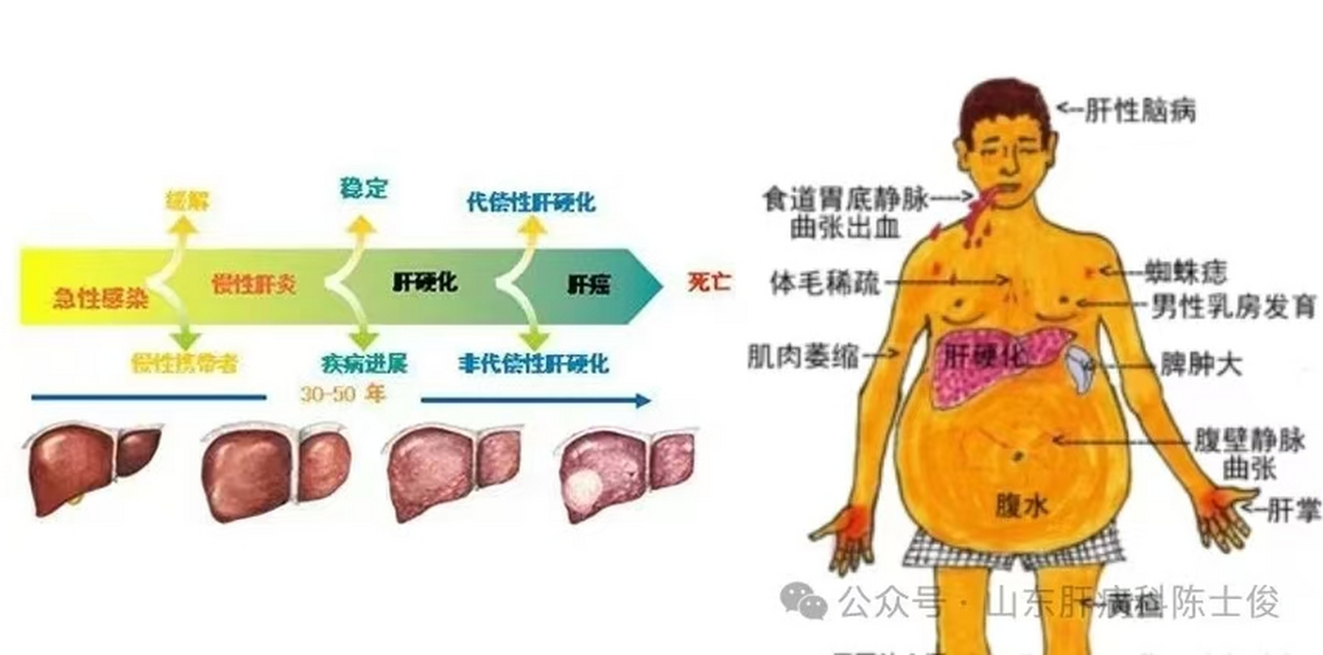 肝硬化机制图图片