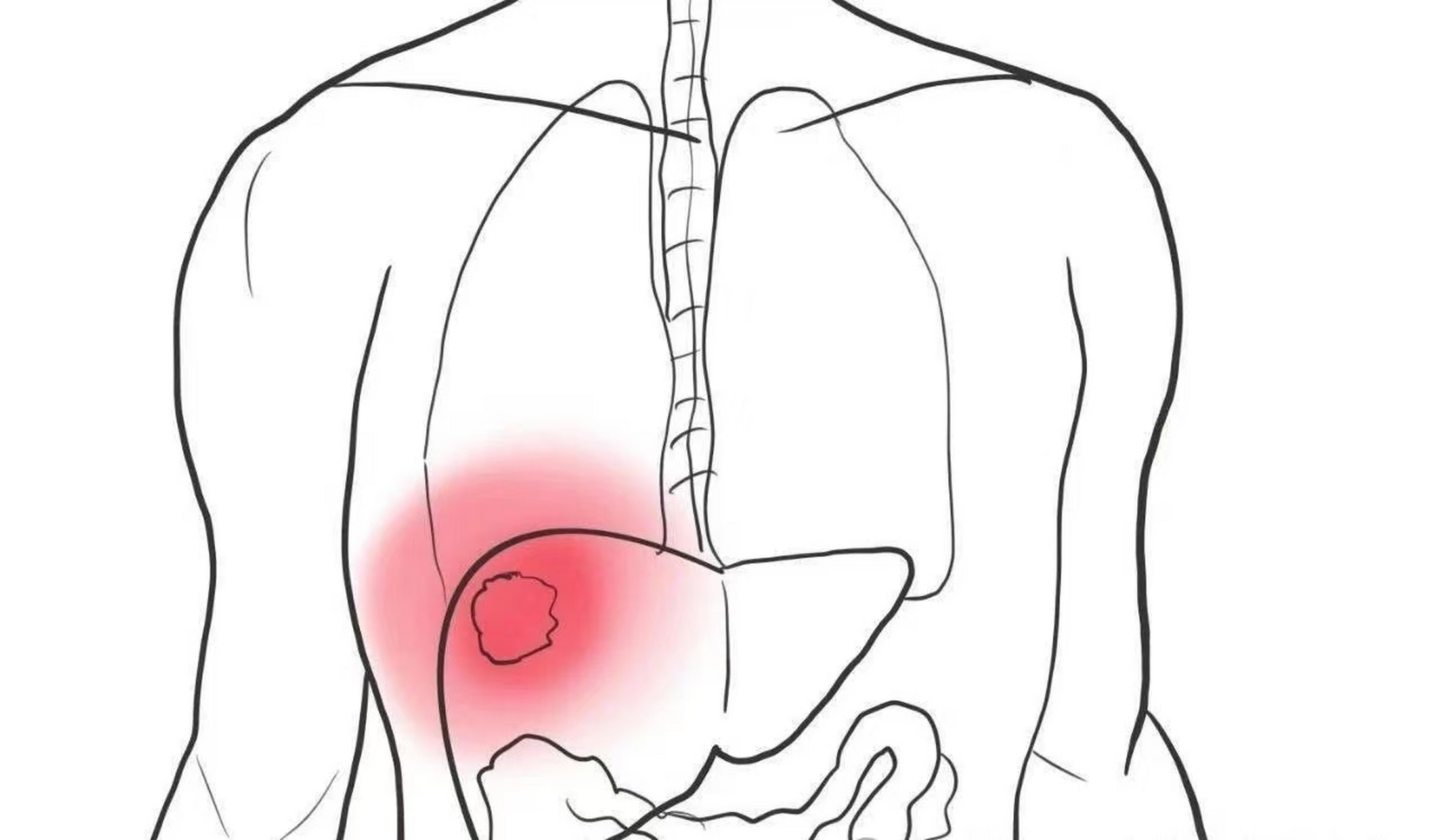 肝癌早期2个地方出现异常,一般人会忽视,错过很可惜!