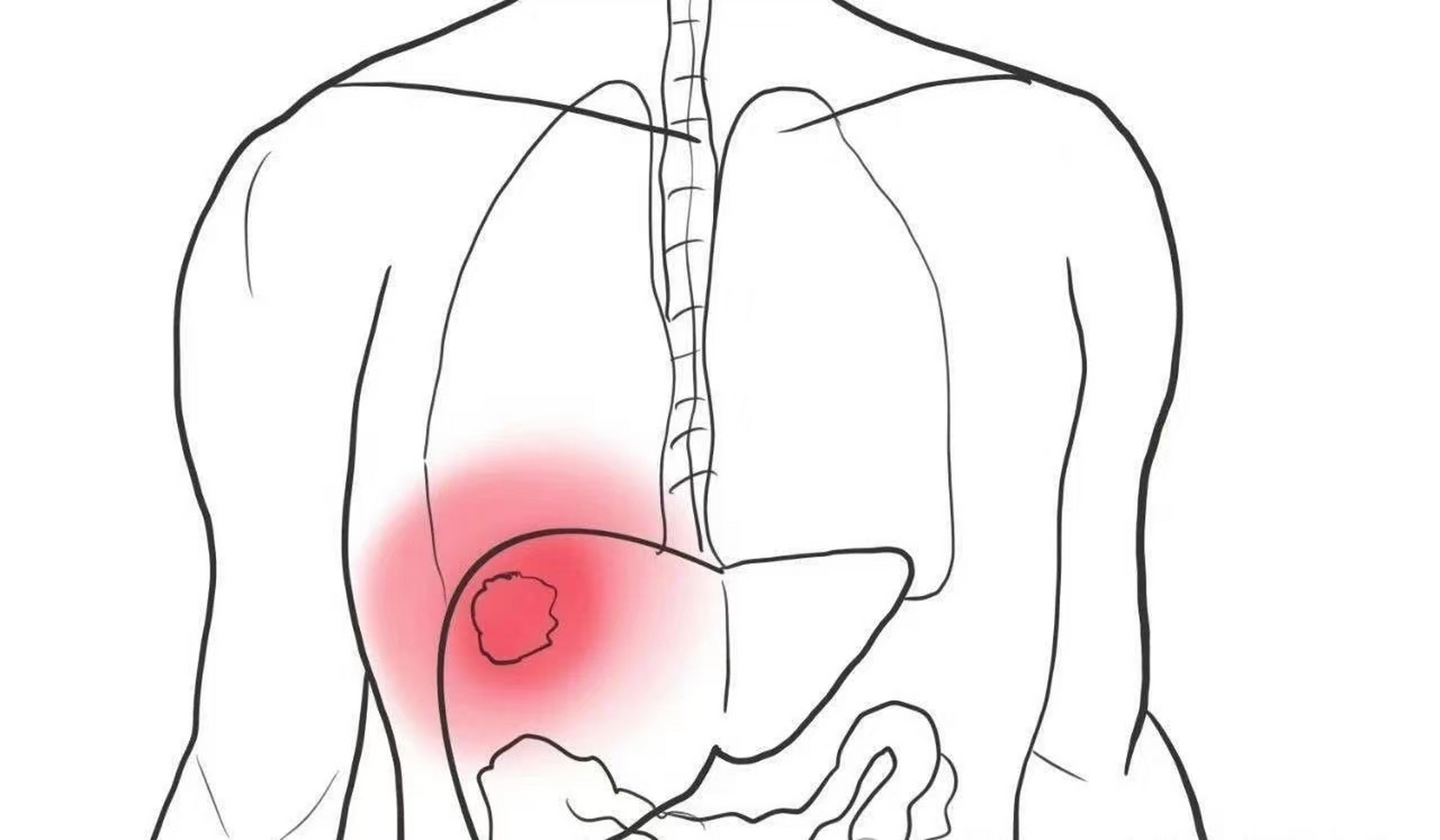肝癌右肩痛位置图片图片