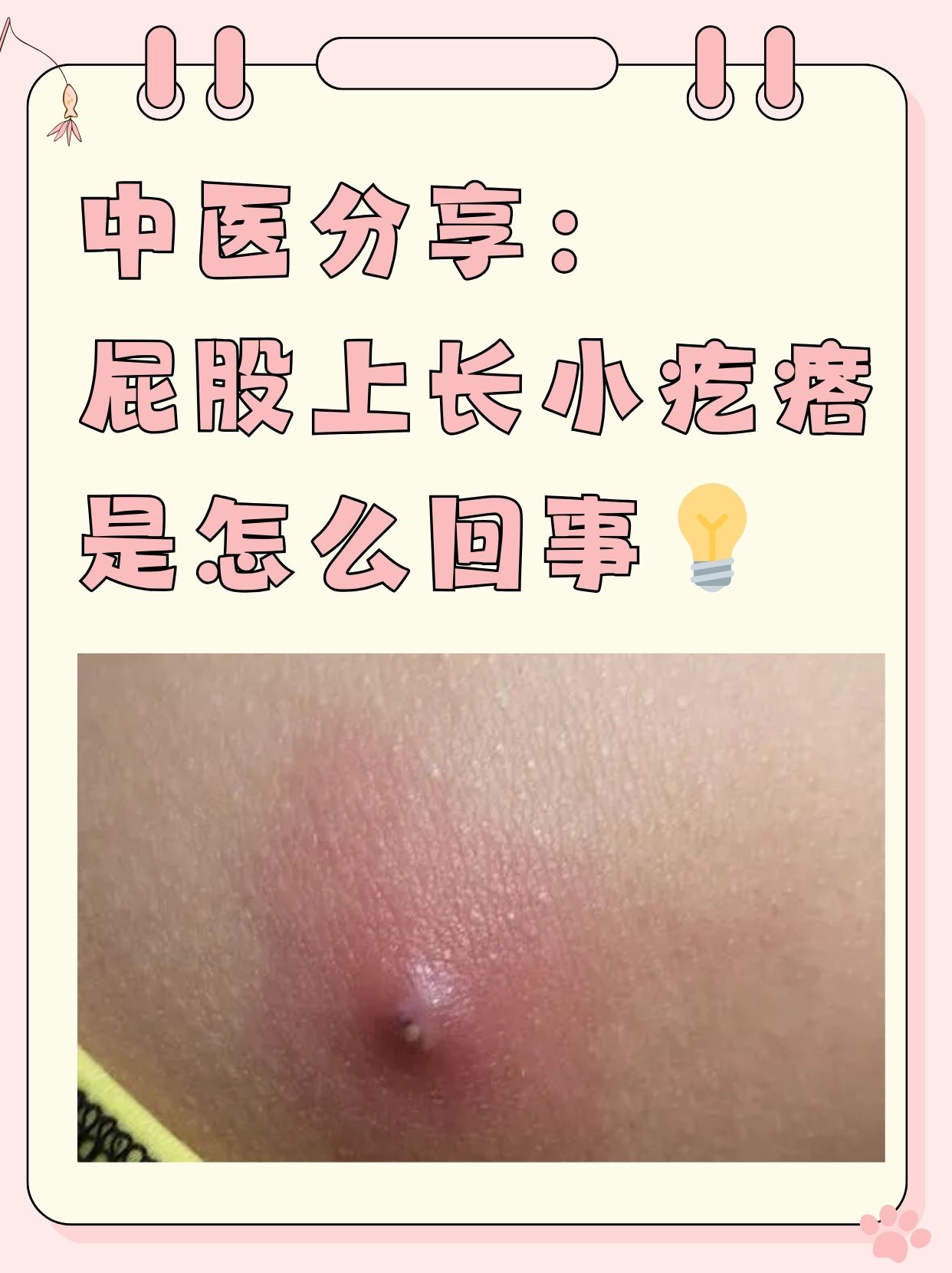 中医分享:屁股上长小疙瘩是怎么回事 不少朋友可能都曾遭遇过这样的