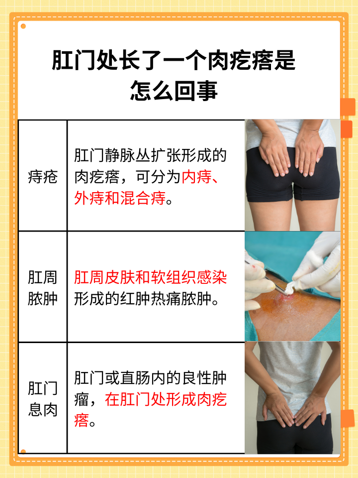 肉疙瘩的出现可能是多种肛周疾病的信号