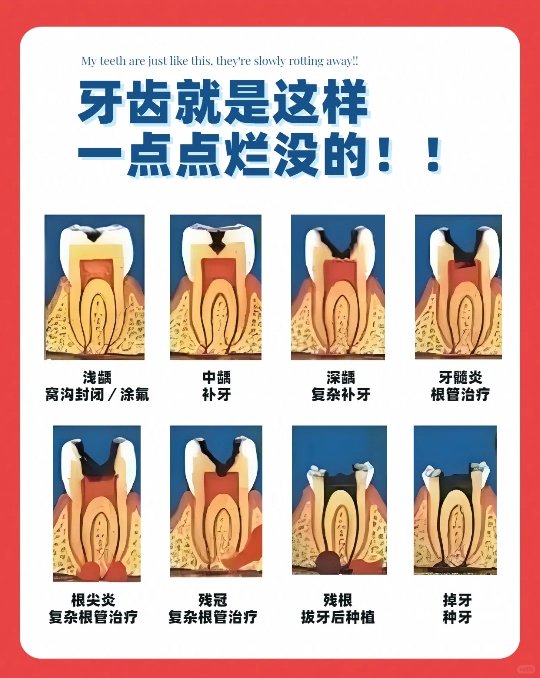 牙齿龋坏是有一个阶段性的过程的,牙齿会给了我们很多提示可不要