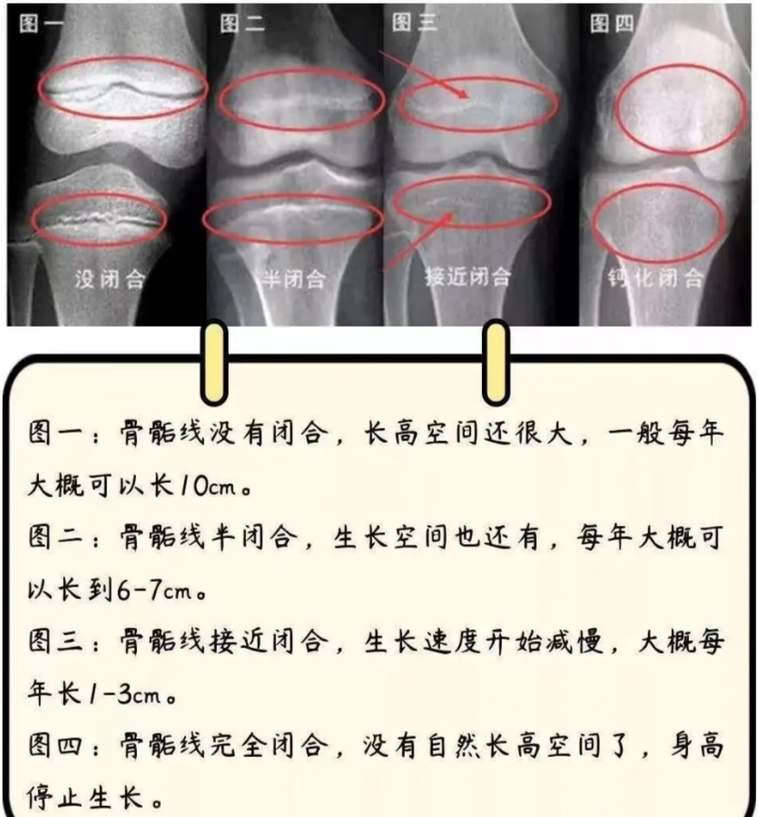 清华大学玉泉医院儿科易维芬主任:教你如何判断孩子骨骺线是否闭合?