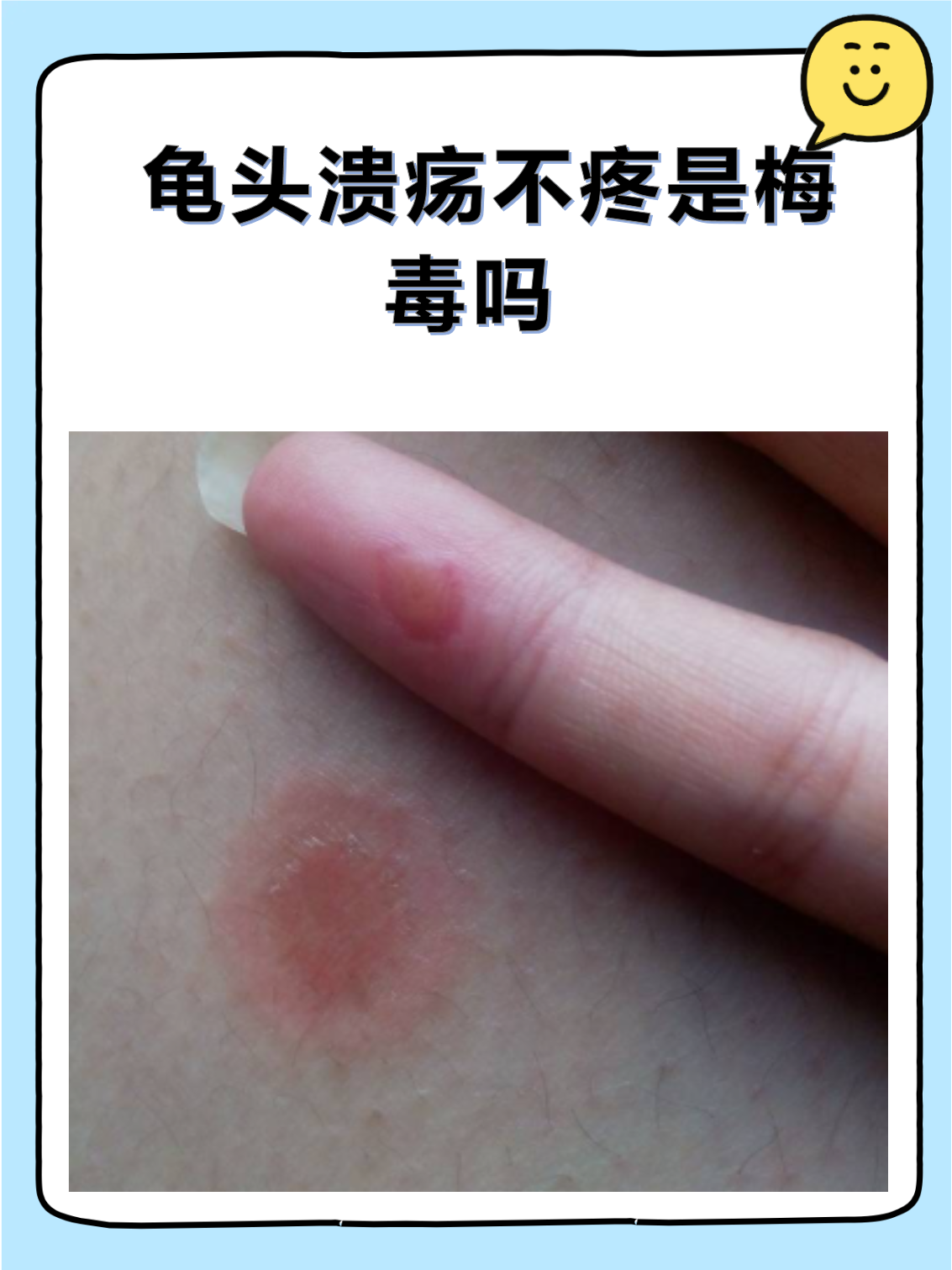 龟头出现溃疡但无疼痛感,确实容易联想到梅毒