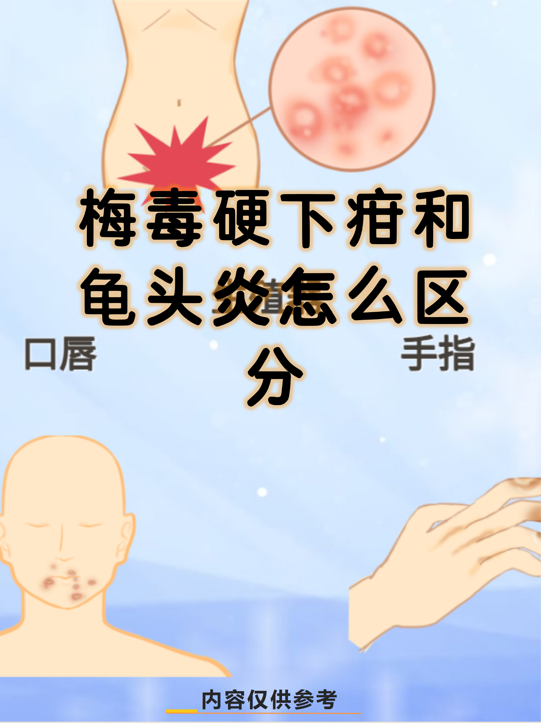 梅毒硬下疳和龟头炎虽然都可能出现在生殖器部位,但两者的病因,症状