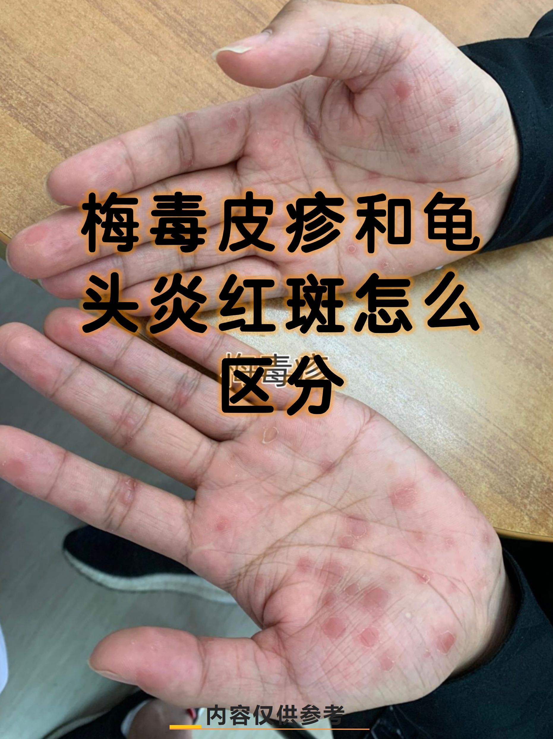 梅毒皮疹和龟头炎红斑怎么区分