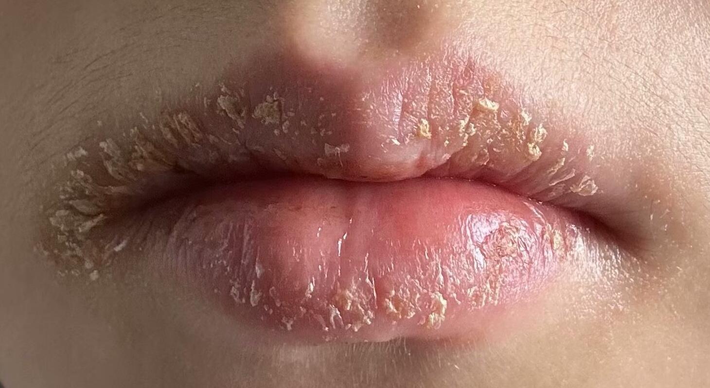 患者王女士,40岁,因"嘴唇总干裂,起皮,红肿"来到我的门诊