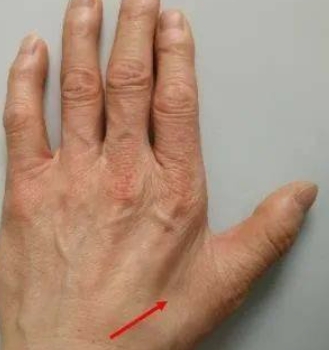 就是今天上午,有一个病友找到我问我说:我的手上肌肉萎缩了,然后有