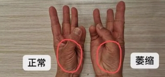 症状手图片渐冻症肌肉萎缩图片大鱼际萎缩图片萎缩渐冻症早期症状图片