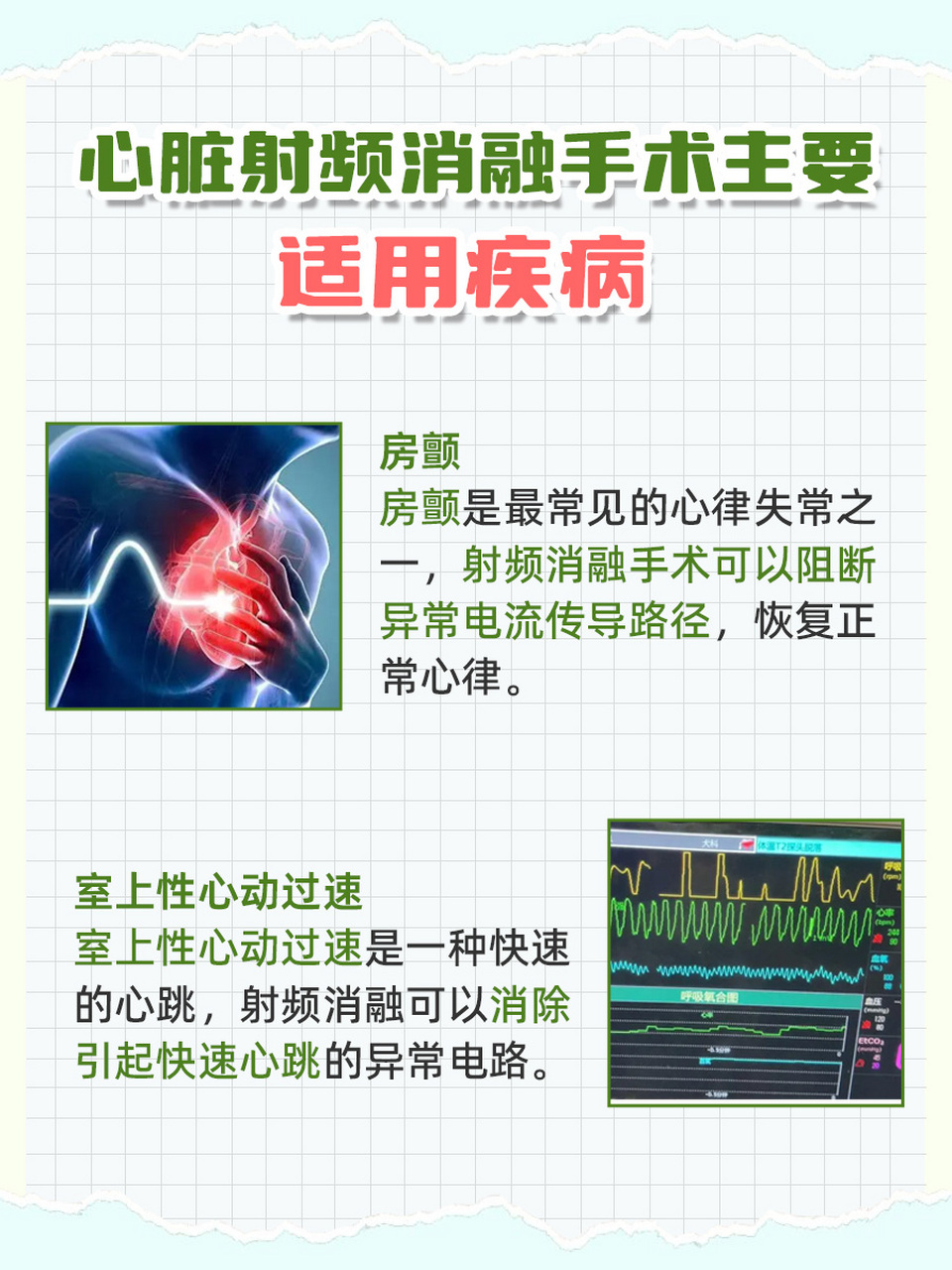 �心脏射频消融手术,是通过导管将射频能量精准送达心脏内异常