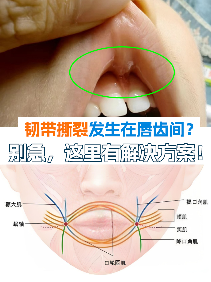 在日常生活中,唇系带可能会因为各种原因发生撕裂,如摔倒,碰撞,不正