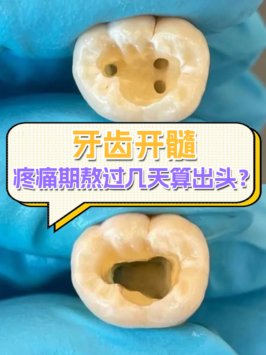 牙齿开髓,疼痛期熬过几天算出头?