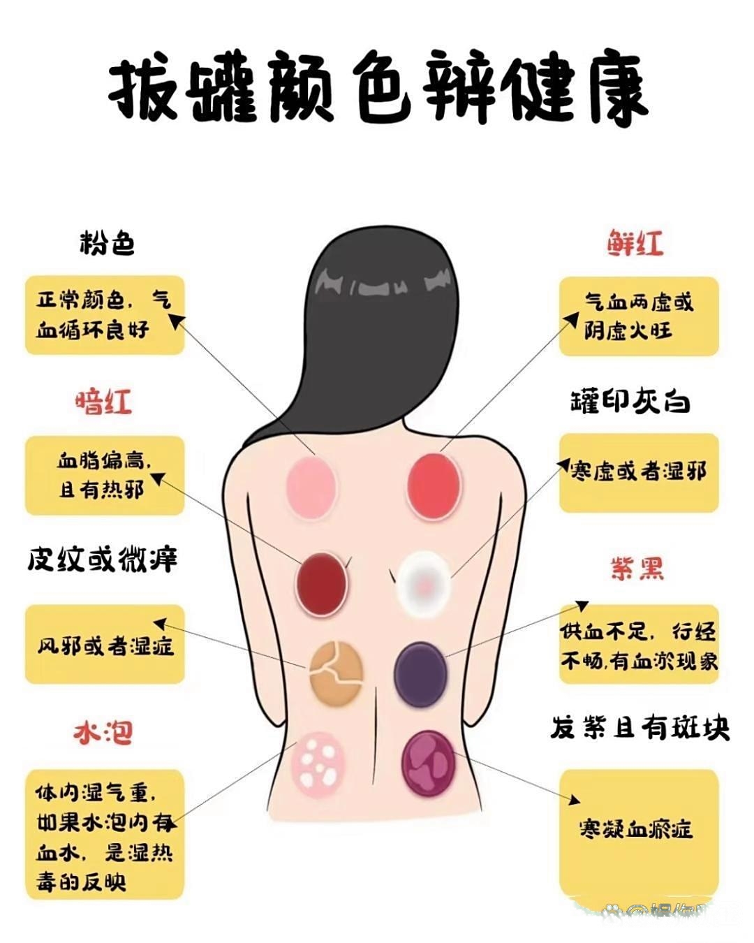 拔罐后背上印出的不同颜色,真能看出身上不同部位的健康状况呢!
