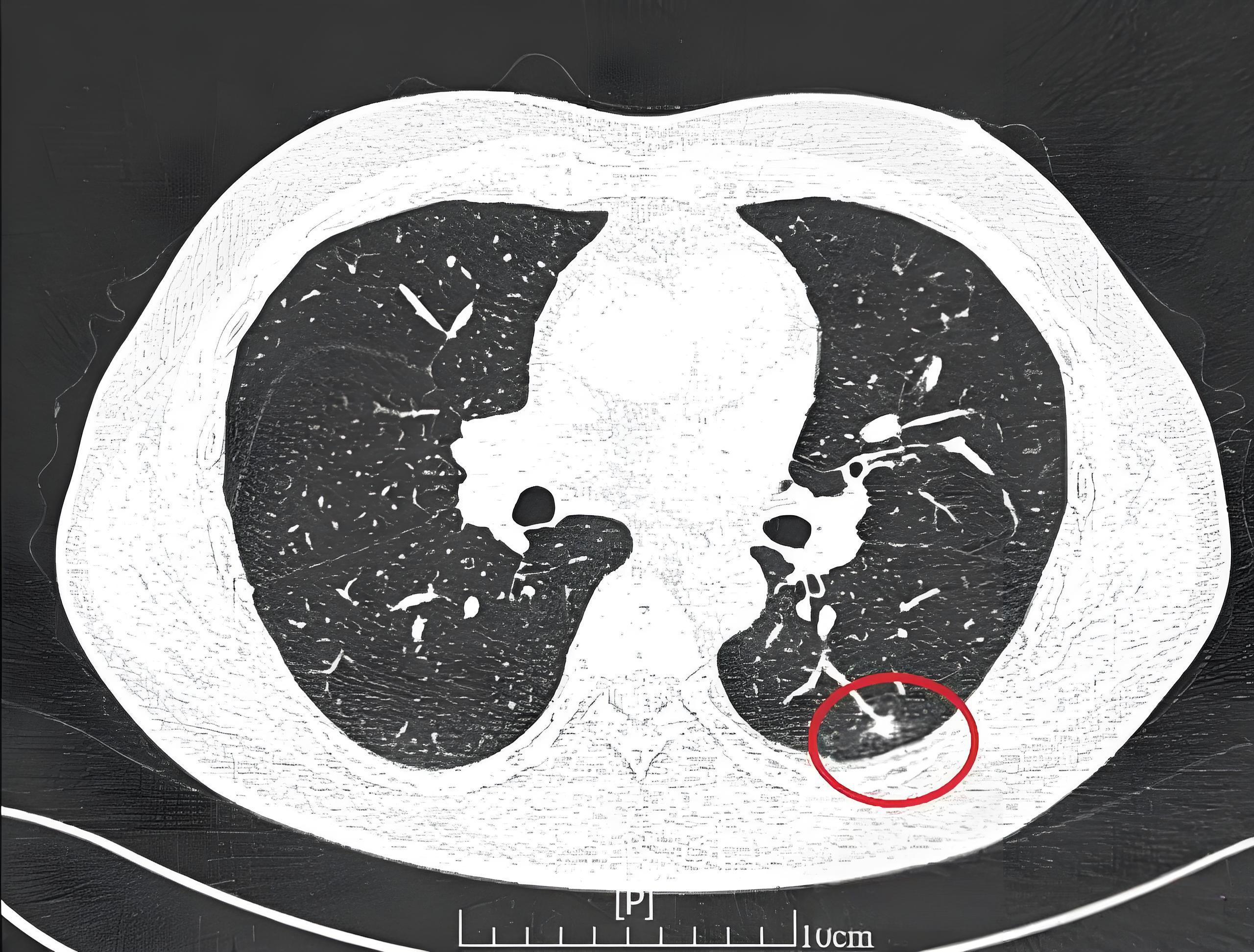 肺结节刚出现,极小,多因体检 ct 偶然发现,身体基本没症状,结节在影像