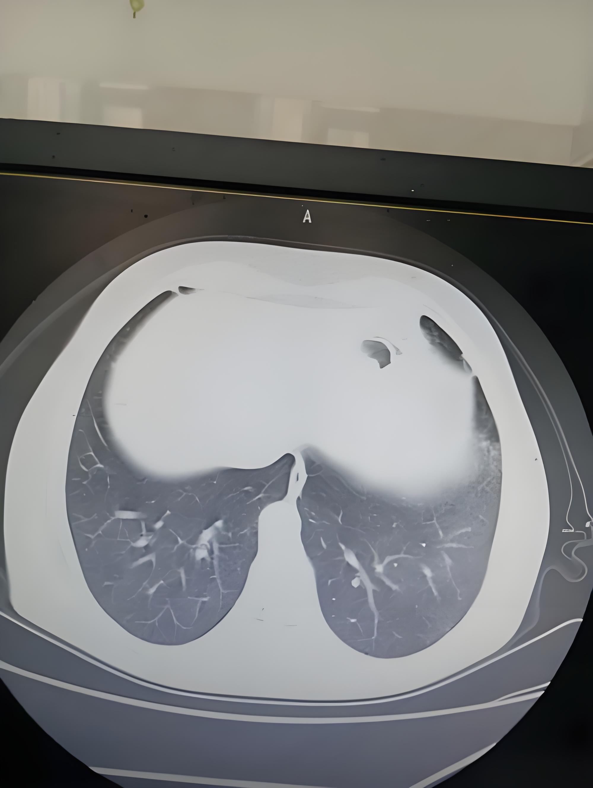 危害:增加水钠潴留→血压升高→影响肺部血液