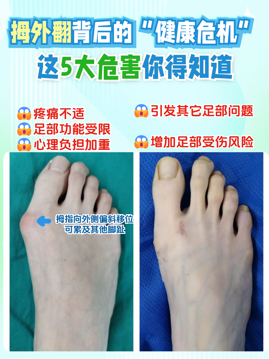 外翻背后的"健康危机":这5大危害你得知道