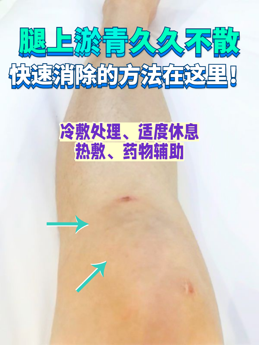 腿上淤青久久不散,快速消除的方法在这里!