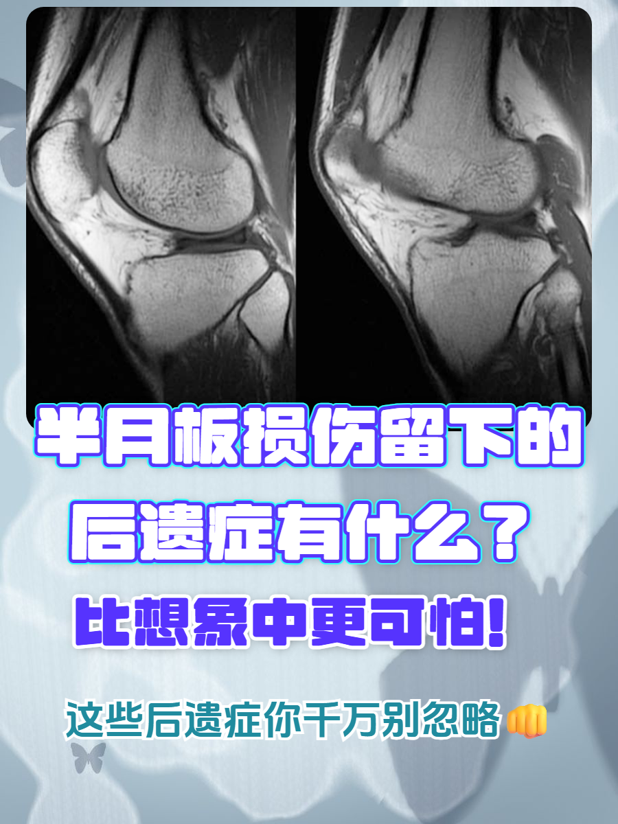 膝关节疼痛反复  损伤后即便表面愈合,受损半月板