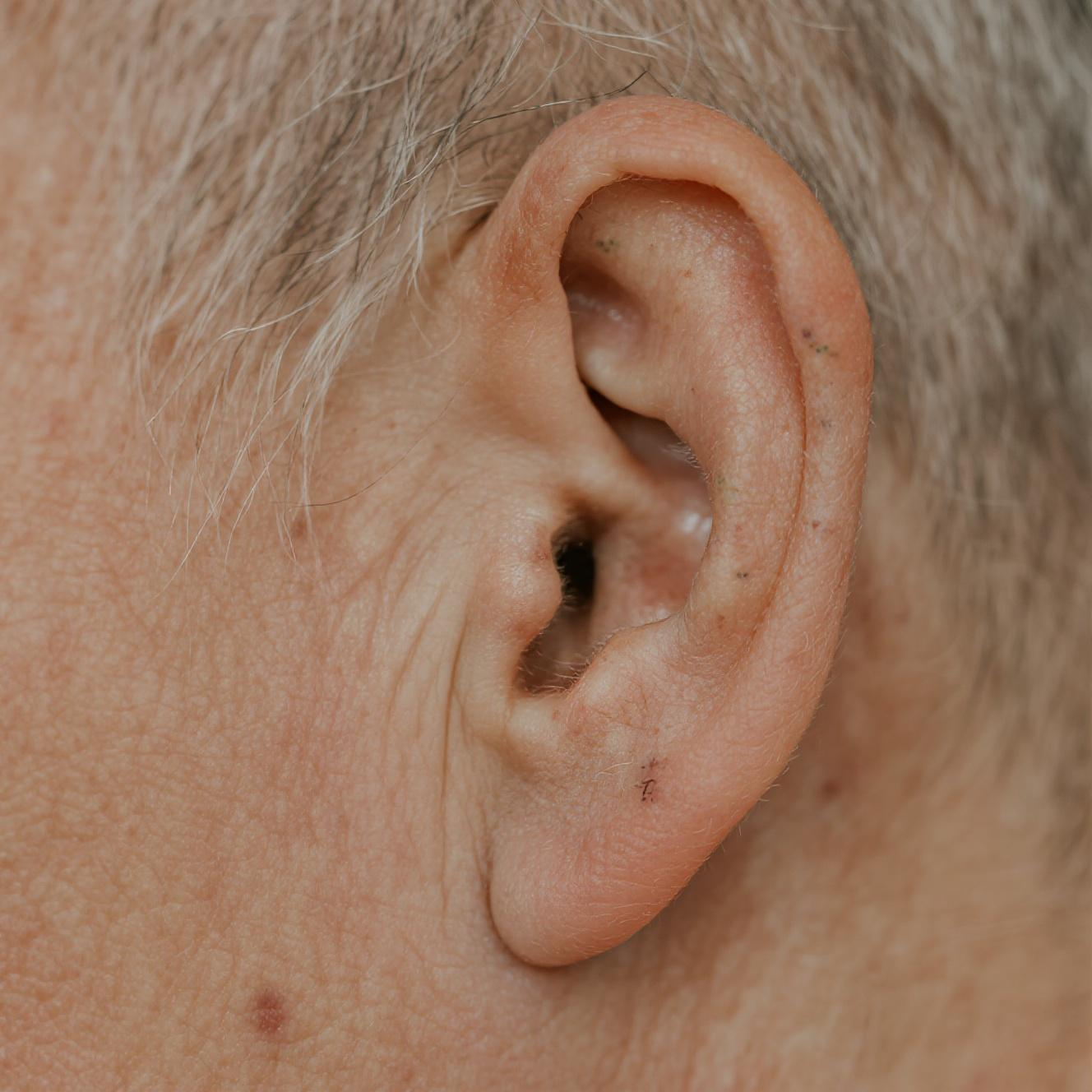 耳垂有痣,原来是老天爷给你要"开后门"的信号,看看你有吗?