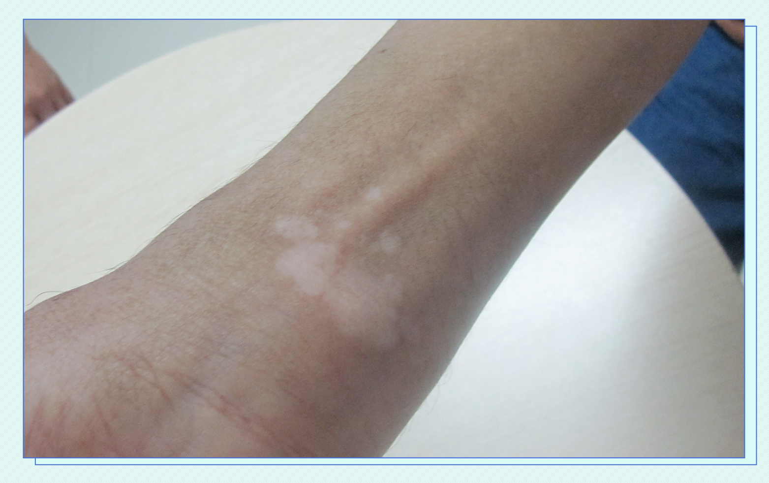 案例:云南50岁男子白癜风晒太阳,白斑反而扩大,医生解释原因