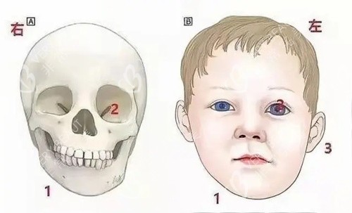 牙床歪斜导致脸嘴都歪图片