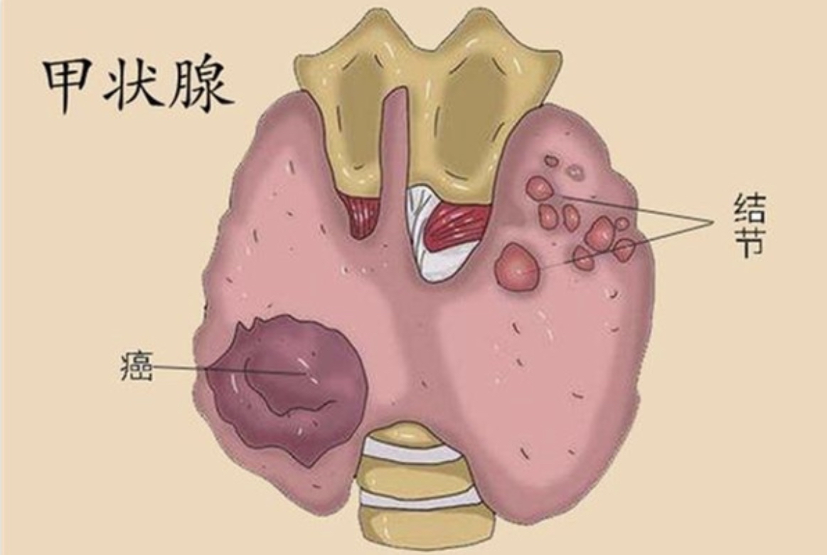 甲状腺结节位置图高清图片