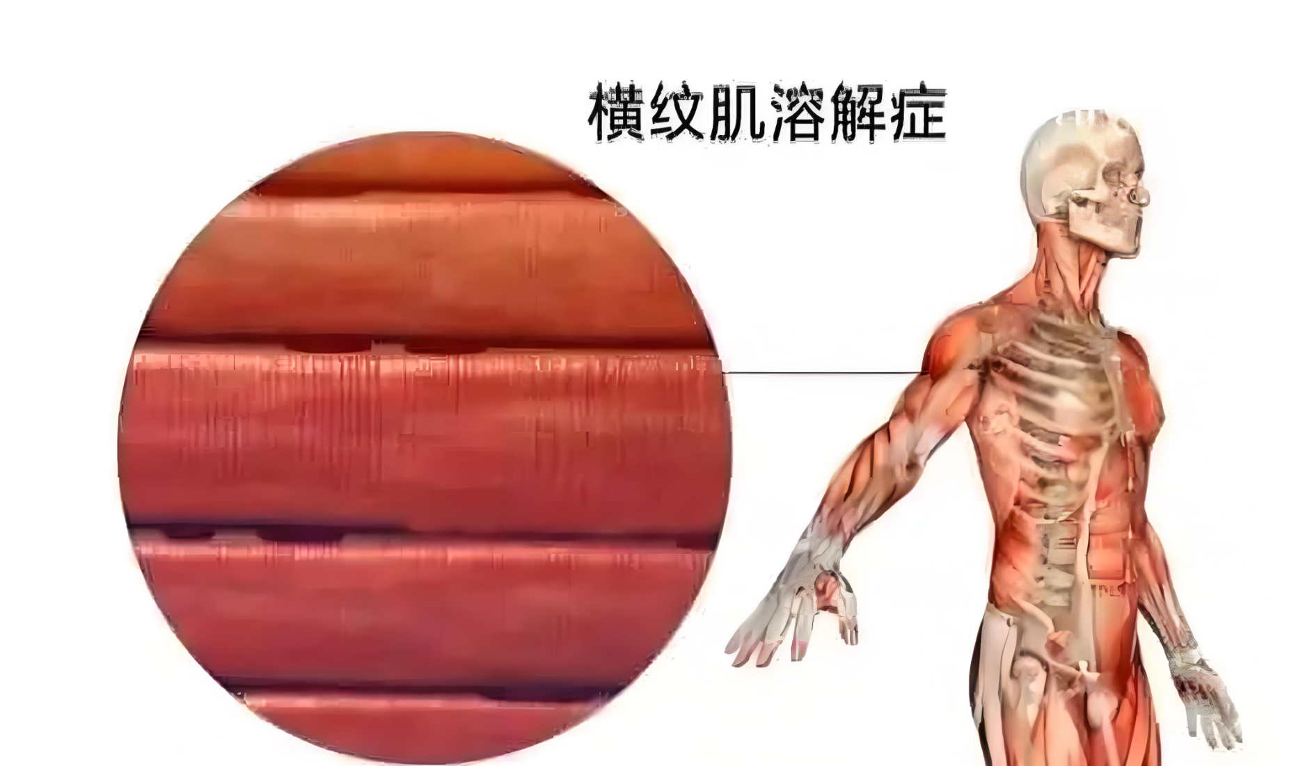 48岁男子高血压服用阿托伐他汀,1年后横纹肌溶解,犯了3个错误