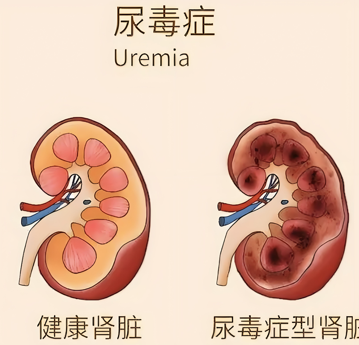 45岁女子肾盂肾炎吃左氧氟沙星,很多人不知道怎么用?