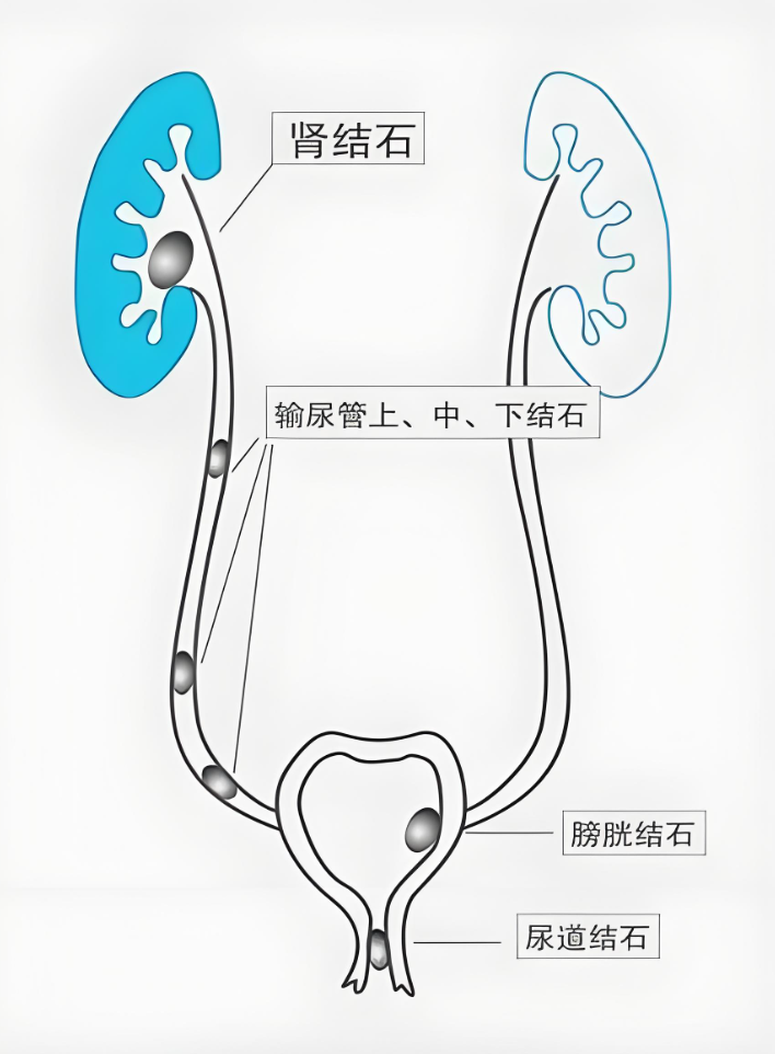 43岁男子输尿管结石吃罗哌卡因,1年后复查,输尿管结石好了吗