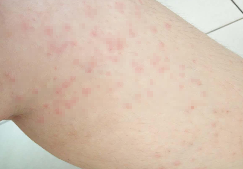 35岁女老板用阿达木单抗治疗银屑病,半年过去,症状消失了吗?