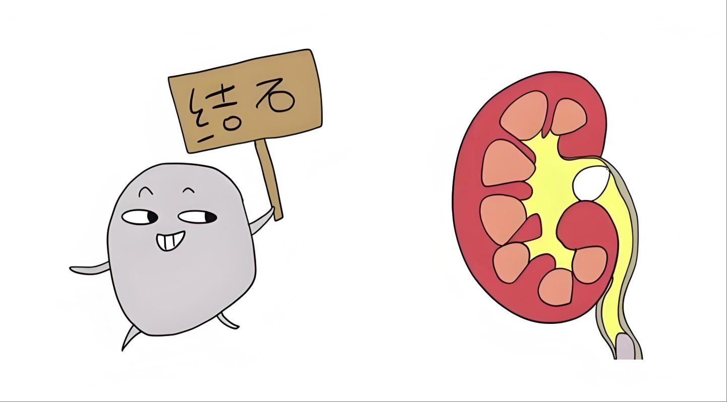 35岁男子肾结石,取石手术成功,术后半年肾衰竭,医生道明3点原因